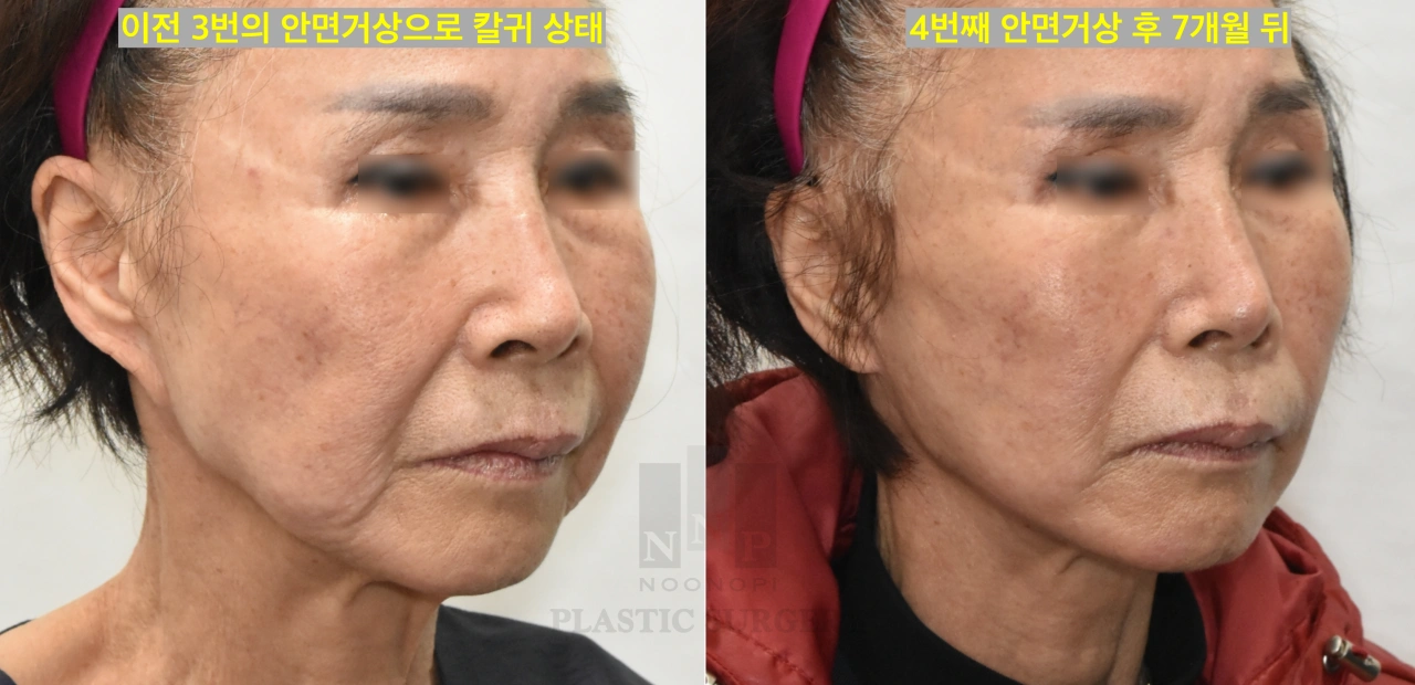 안면거상재수술로 칼귀 교정 전후 모습