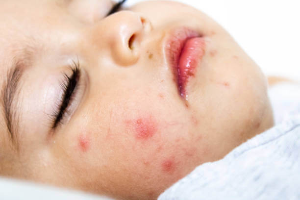 수족구 증상&amp;#44; 전염 및 잠복기와 예방까지! 수족구에 잠복기가 생기는 이유까지 알아봤습니다. 