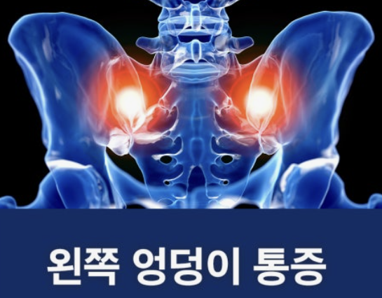 엉덩이 통증&amp;#44; 앉는 것도 고문이었던 3개월의 기록