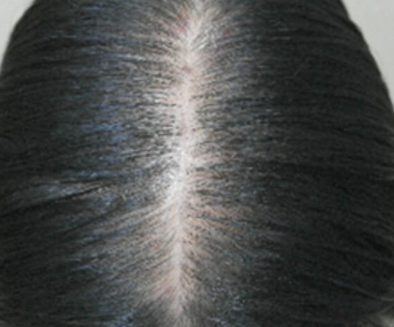 여성 탈모 두피열 낮추는 관리법 사진 2