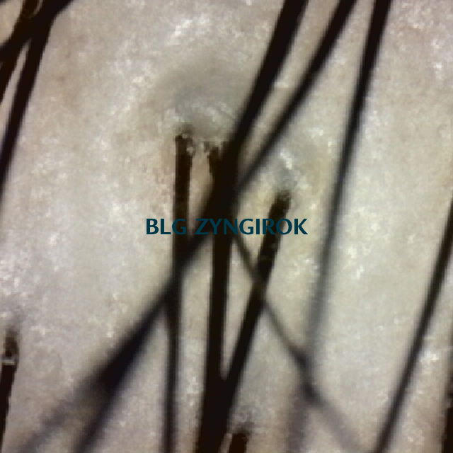 탈모 극복프로젝트 - 피나모아 복용 - 뒷머리 두피사진 모습이다.