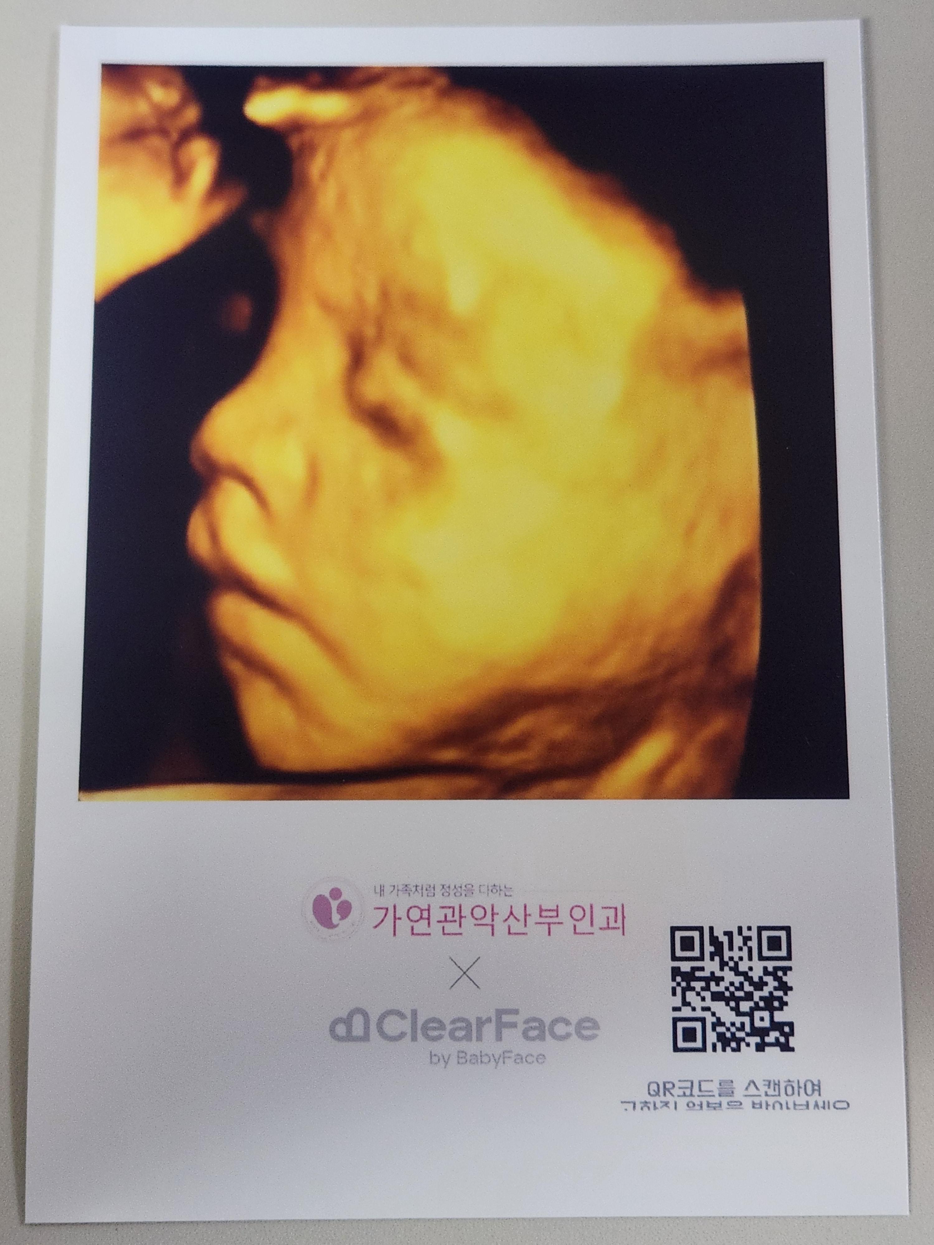 클리어페이스 입체초음파