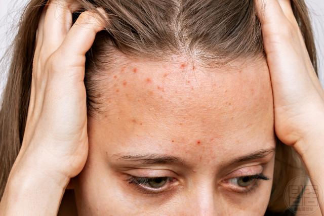 피부장벽 무너짐 증상 여드름