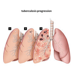 결핵 재발 내성결핵 예방접종 좁쌀결핵