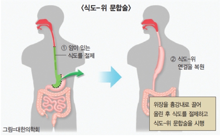 식도-위 문합술