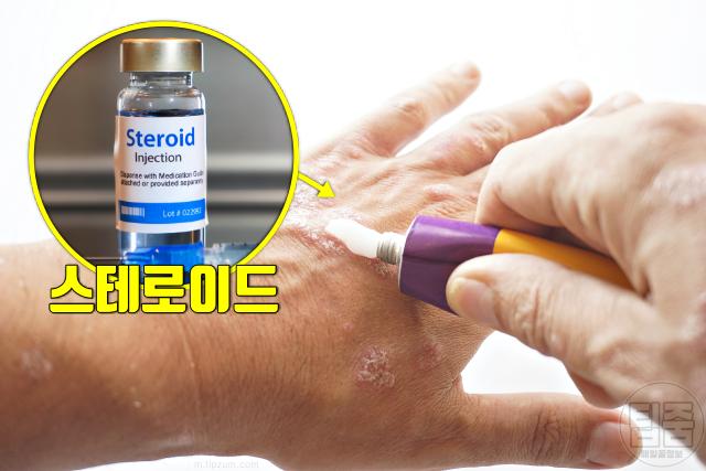 녹내장 잘 걸리는 사람 고위험군 특징 장기간 스테로이드 사용
