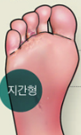 발가락 사이에 무좀이 발생하는 지간형 무좀
