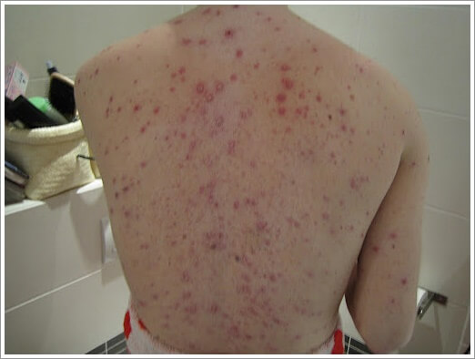 대상포진 초기증상