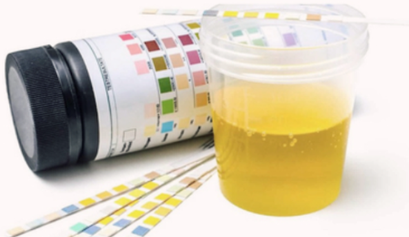 단백뇨의 검사방법