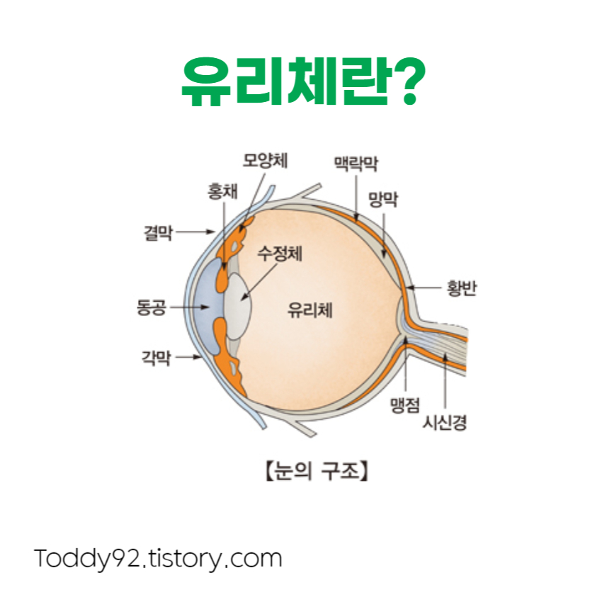 유리체란?