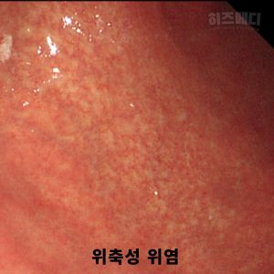 위축성 위염 증상 합병증