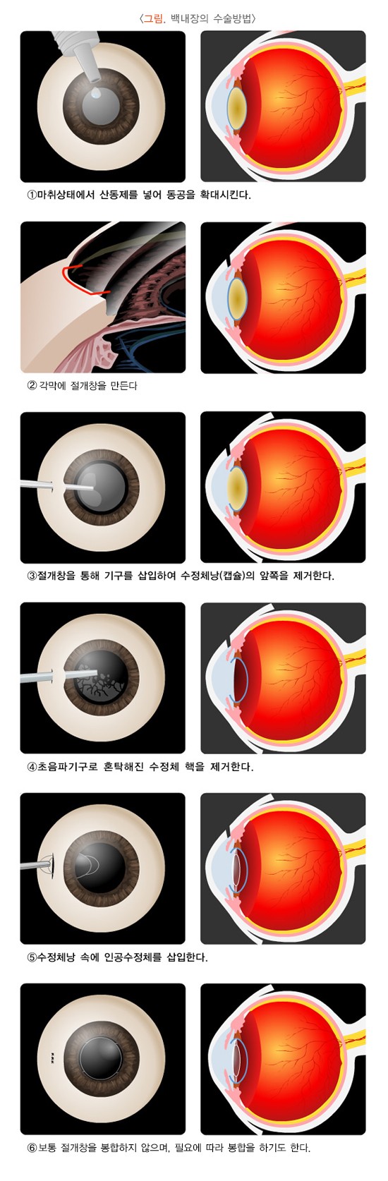 백내장