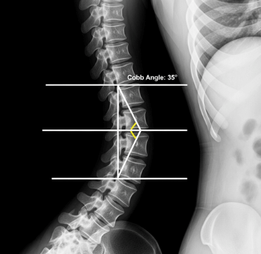 척추 측만증 검사 방법과 병원 선택7