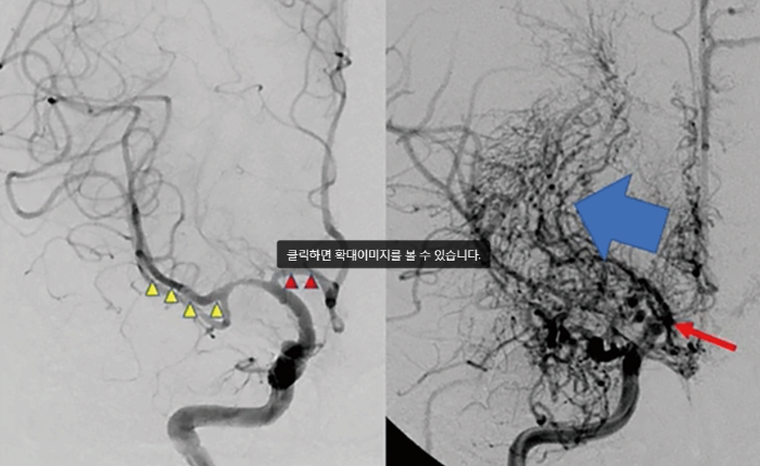 모야모야병-증상-치료-명의-김정은교수-예약-방법