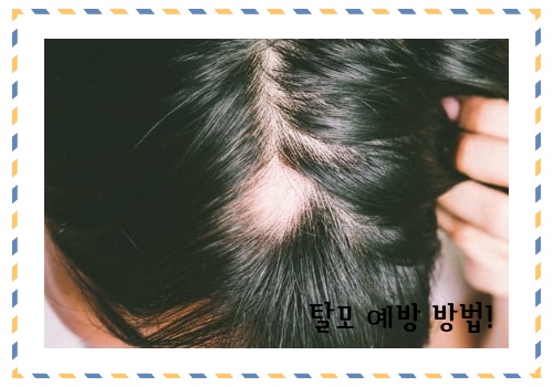 탈모 예방 방법 알아보고 예방