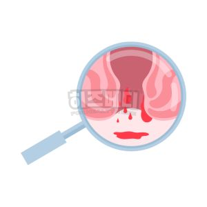 분변 잠혈검사 양성