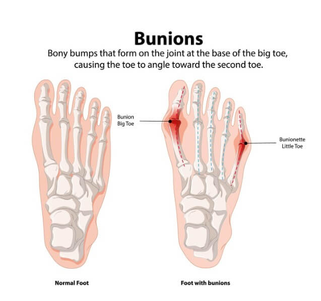 무지외반증 증상