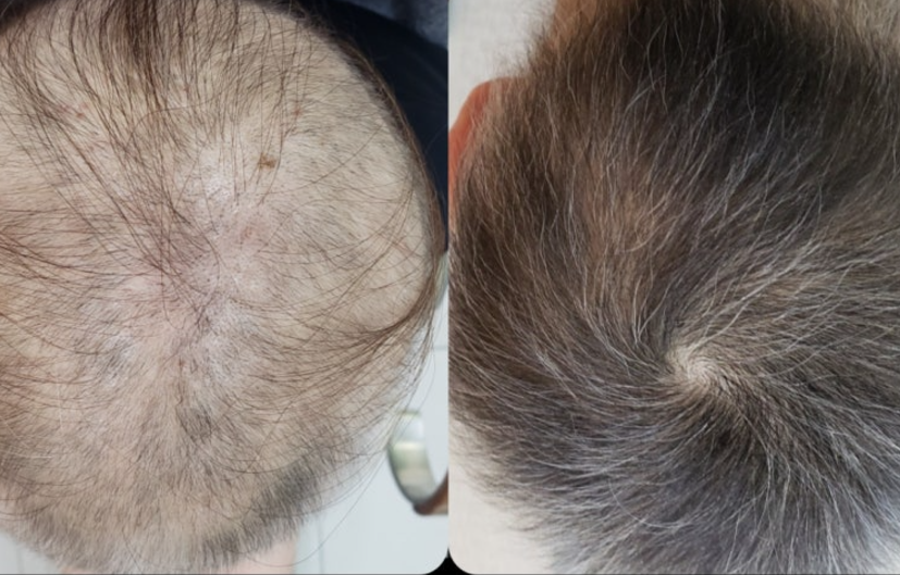 모발이식 3000모 비용 4000모 비용 부작용 과정