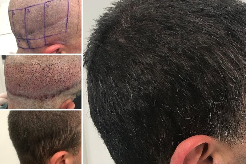 병원별 시술 방식&middot;비용 비교 (서울 강남/압구정)