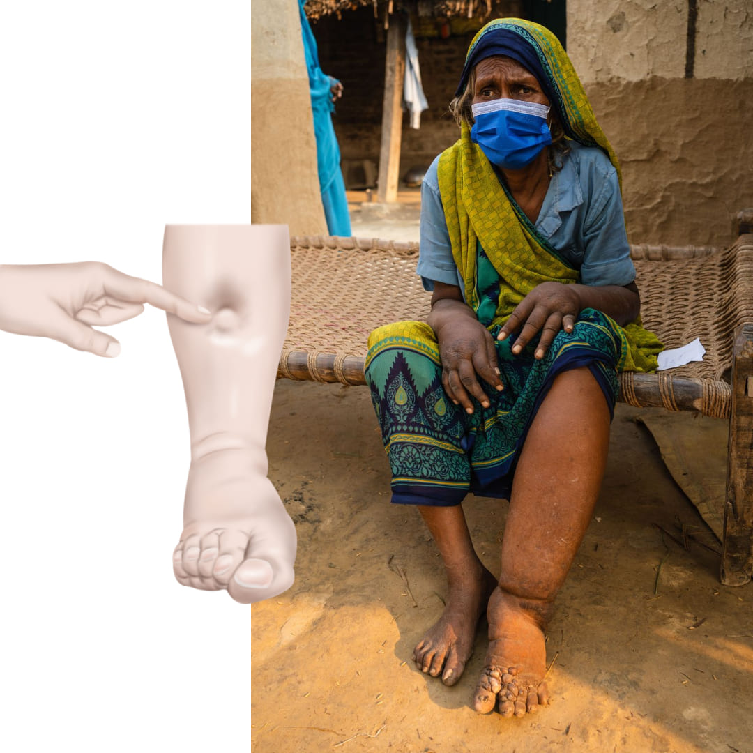 한쪽 다리가 많이 부어서 손가락으로 누르면 푹 눌러지는 노인