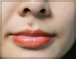 인중 여드름 위험성을 나타내는 안면위험삼각지대 설명 이미지로 피부 관리와 올바른 스킨케어 방법에 대한 교육 정보를 담은 자료