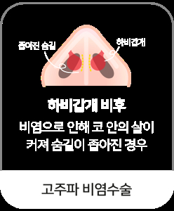 비염 수술