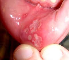 혓바늘 없애는 방법