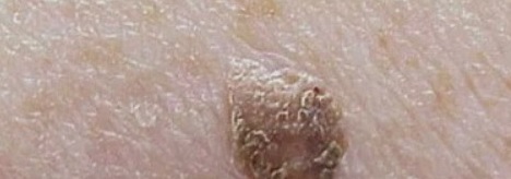 지루각화증-위암