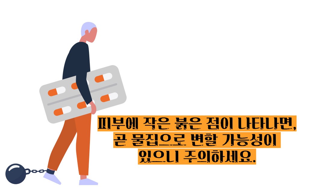 대상포진 초기증상