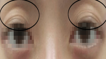 눈두덩이 지방이식 하기 전 남성의 모습
