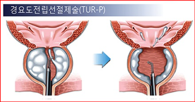 alt="경요도 전립선 절제술 (TUR-P)"