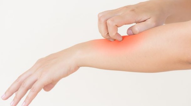 skeeter syndrome