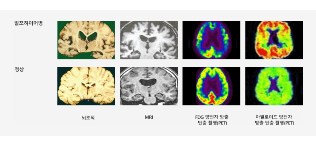 치매초기증상,치매진행순서,치매대응,치매증상,노인건강,치매가족,치매대처법,인지장애,경도인지장애,치매체크리스트