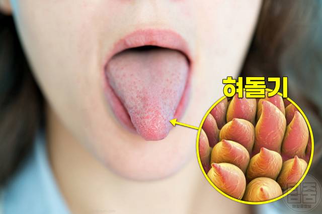 혀백태 원인 제거 혀 백태 안없어짐