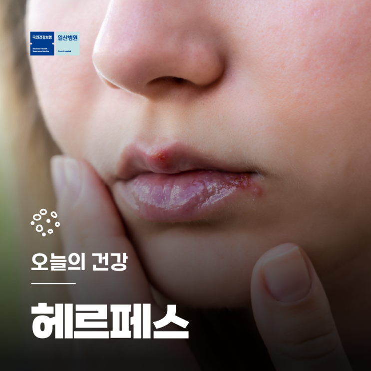 입술 헤르페스