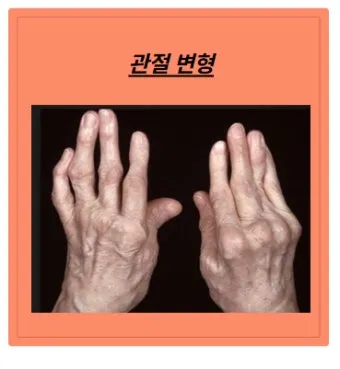 효과적인 류마티스 관절염 치료제 추천 약물 비교 가이드 2025 최신판_17