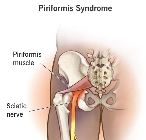 이상근 증후군 원인