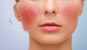 얼굴이 붉어지는 증상