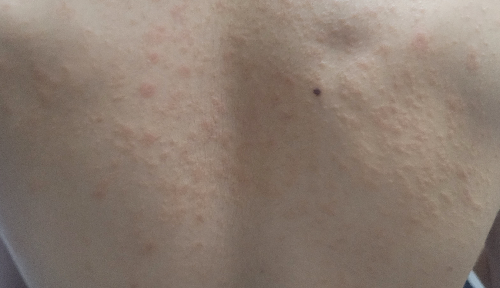 장미색 비강진 후기