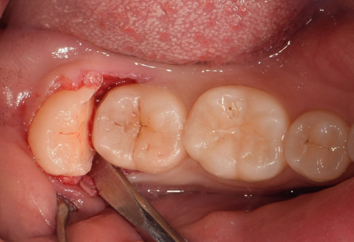 사랑니 발치 후 식사 가이드