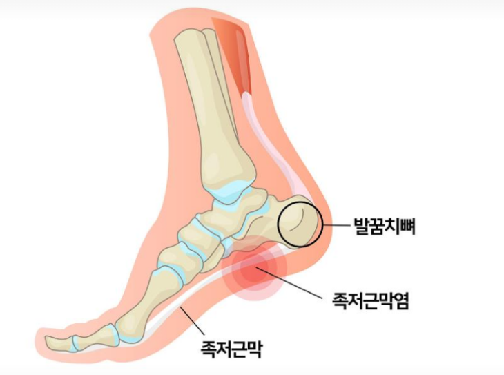 발 골격과 족저근막염 이미지