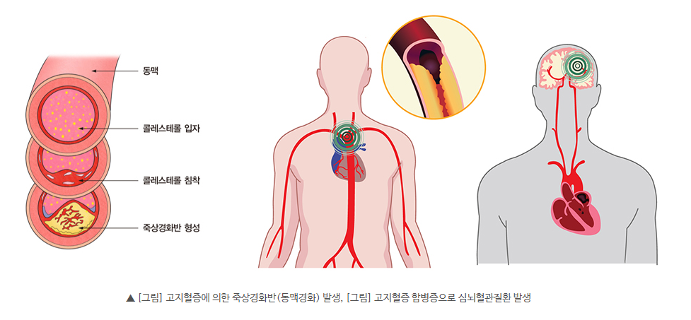 고지혈증 증상과 수치, 고지혈증에 좋은 음식