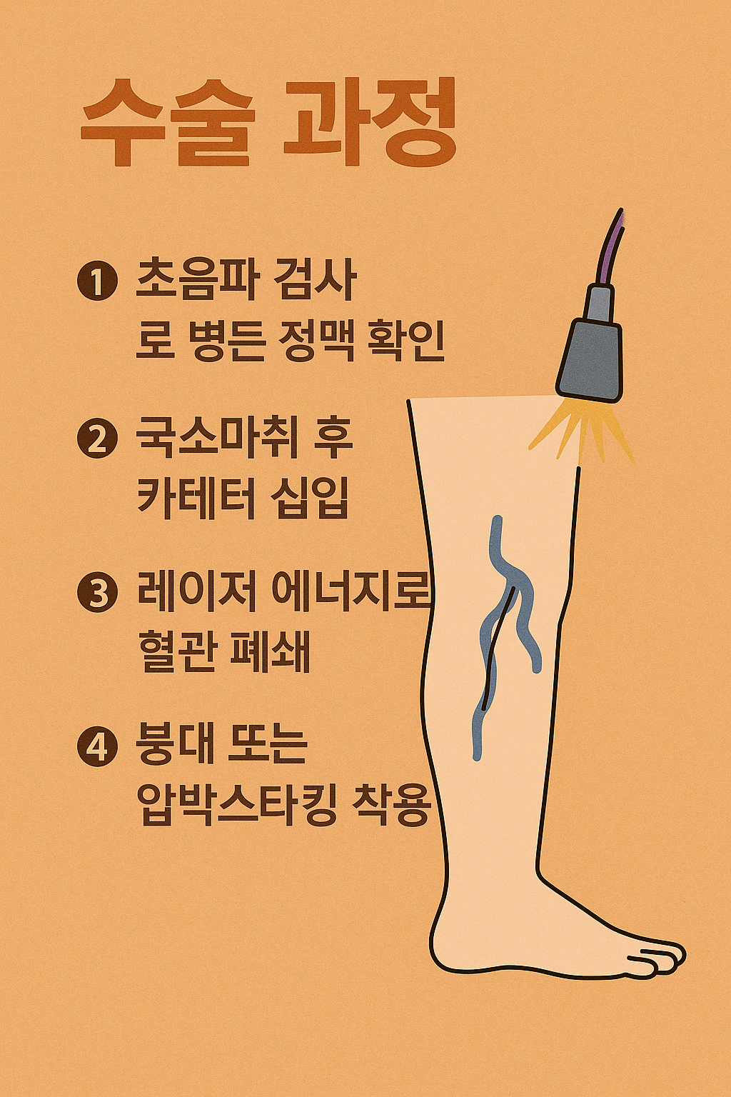 하지정맥류
