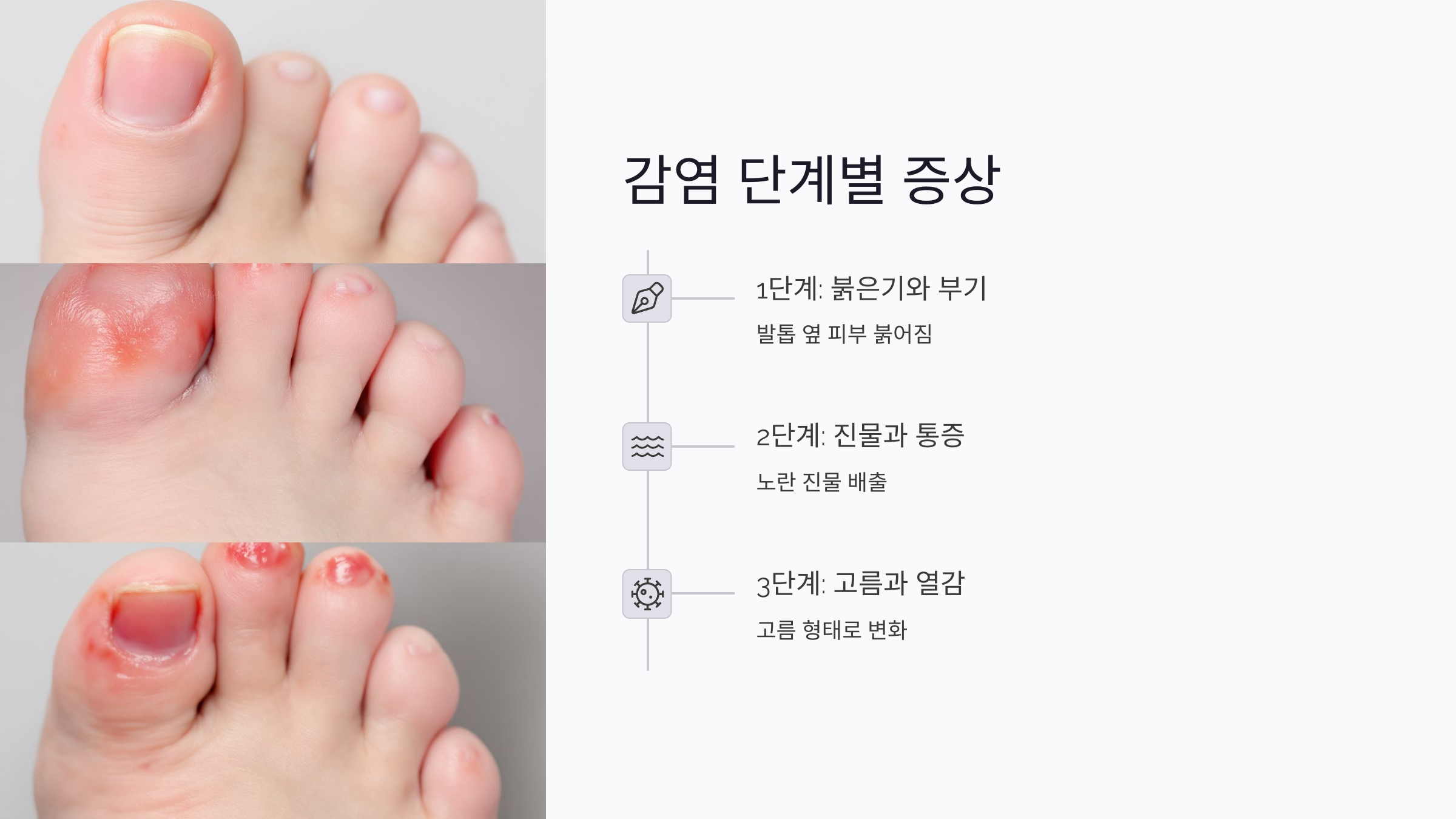 내성발톱 고름 생겼을 때 대처법부터 항생제 치료 시기까지 정리