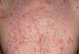 온몸이 가려운 증상