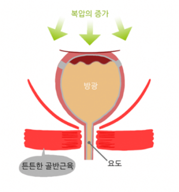 요실금_수술_후_회복기간_부작용_비용_보험적용여부