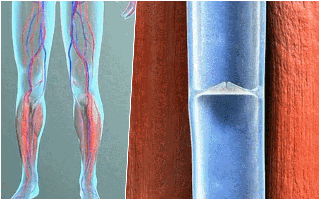 종아리 굵기 건강, 종아리굵기 짝짝, 팁줌