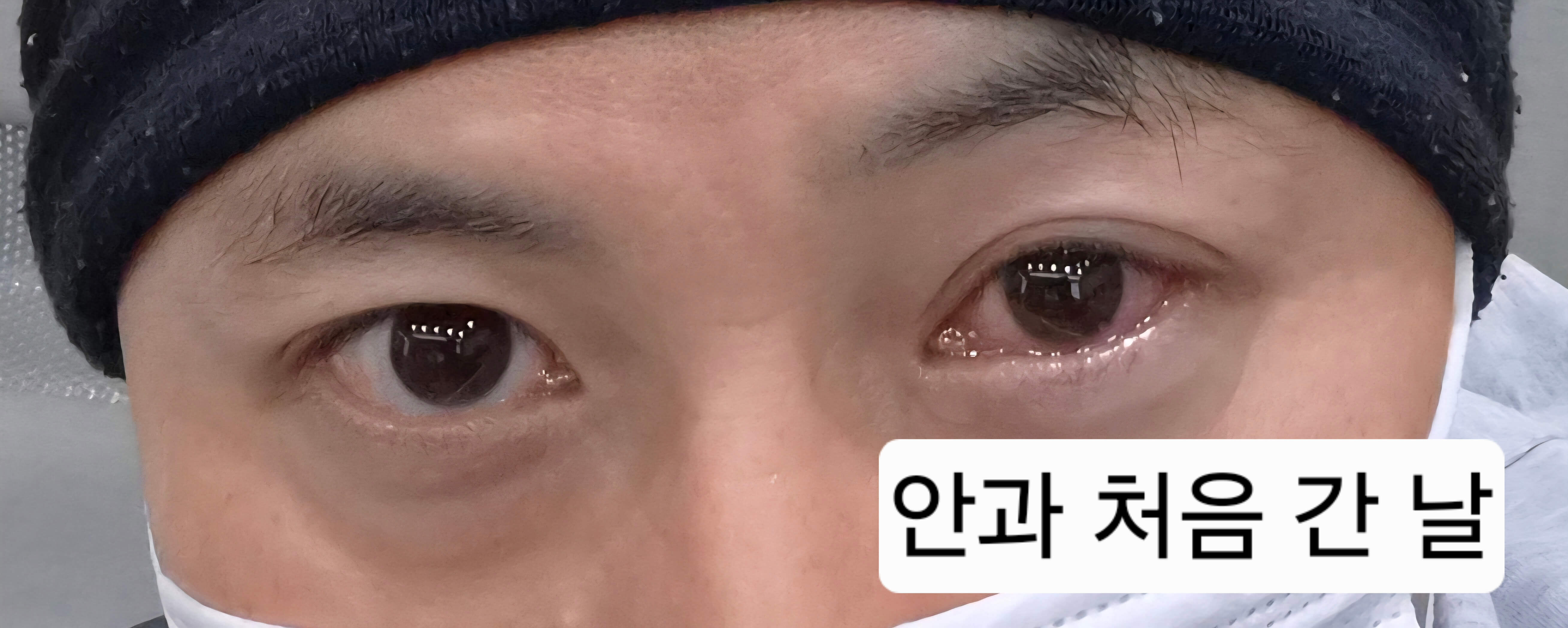 유행성각결막염 눈병 초기증상부터 12일차 치료 기록(진행 중)