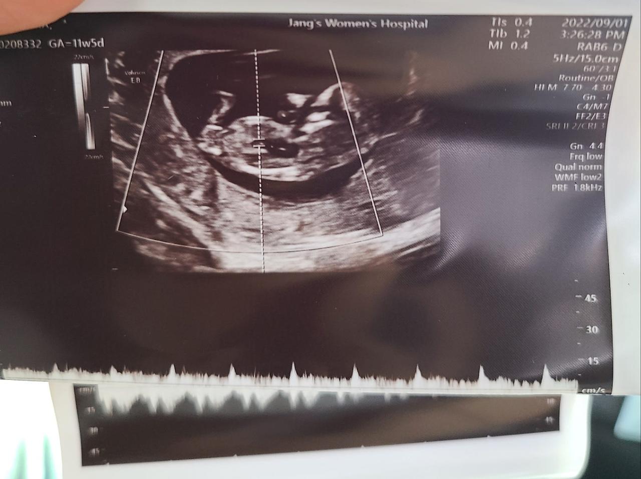 뱃속 태아의 초음파 사진