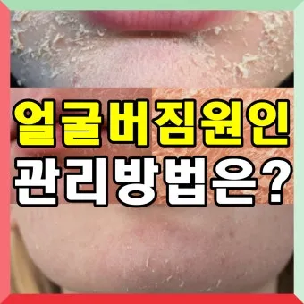 얼굴 버짐 증상 없애는 실전 방법 5가지 및 관리요령_18